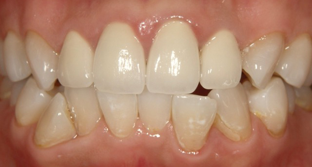 枚方市樟葉の歯医者、たかぎ歯科クリニックのセラミック症例