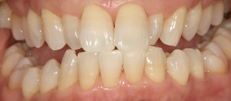 枚方市樟葉の歯医者、たかぎ歯科クリニックのホームホワイトニング症例