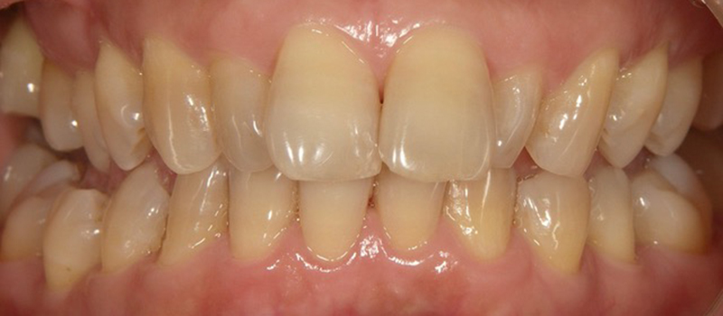 枚方市樟葉の歯医者、たかぎ歯科クリニックのホームホワイトニング症例