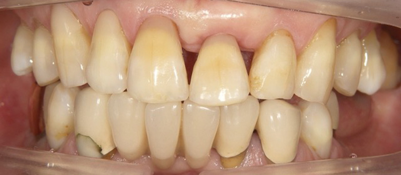 枚方市樟葉の歯医者、たかぎ歯科クリニックのホームホワイトニング症例