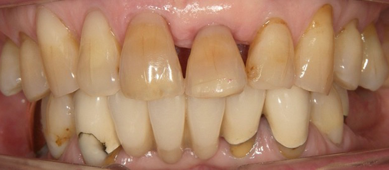 枚方市樟葉の歯医者、たかぎ歯科クリニックのホームホワイトニング症例