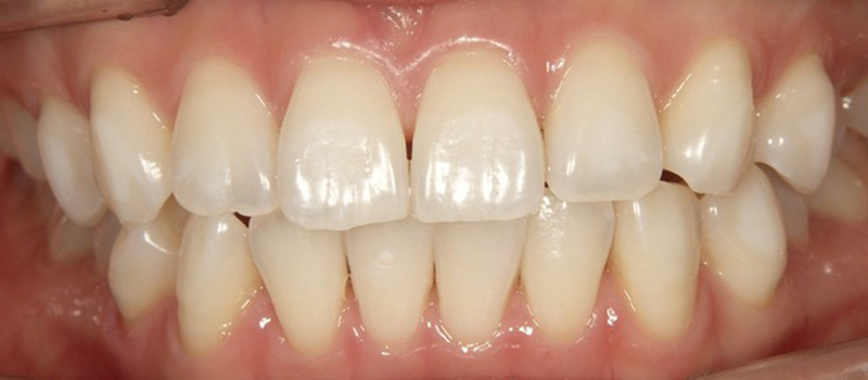 枚方市樟葉の歯医者、たかぎ歯科クリニックのホームホワイトニング症例