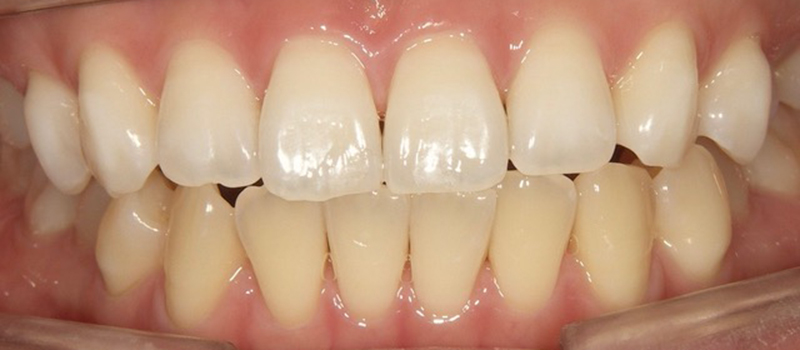 枚方市樟葉の歯医者、たかぎ歯科クリニックのホームホワイトニング症例