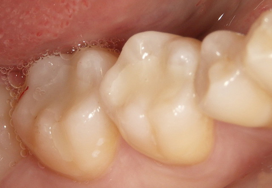 枚方市樟葉の歯医者、たかぎ歯科クリニックの詰め物・被せ物症例
