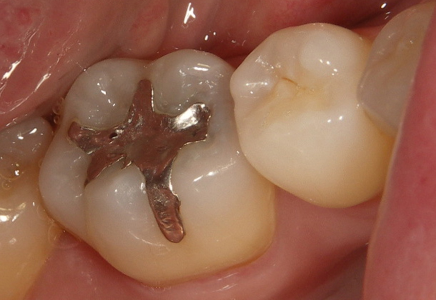 枚方市樟葉の歯医者、たかぎ歯科クリニックの詰め物・被せ物症例